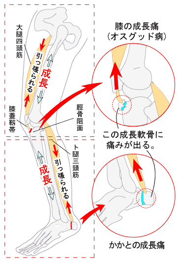 シーバー病 骨端症 踵の痛み 成長痛